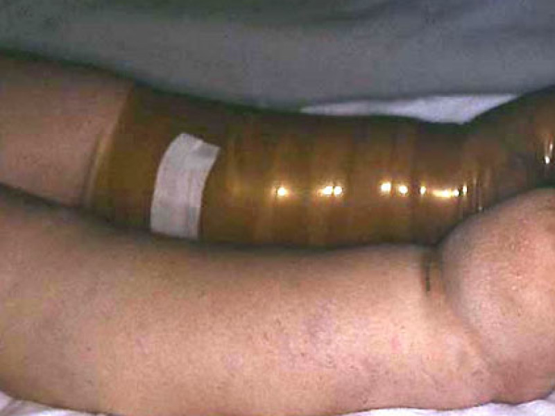 Trattamento compressivo di un linfedema