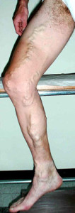 Varici e sport1